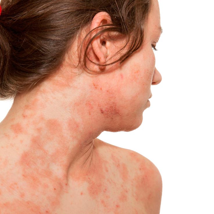 Cómo el estrés provoca dermatitis, erupciones y manchas en la piel