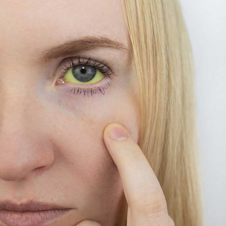 La piel ictérica no es únicamente cosa de bebés