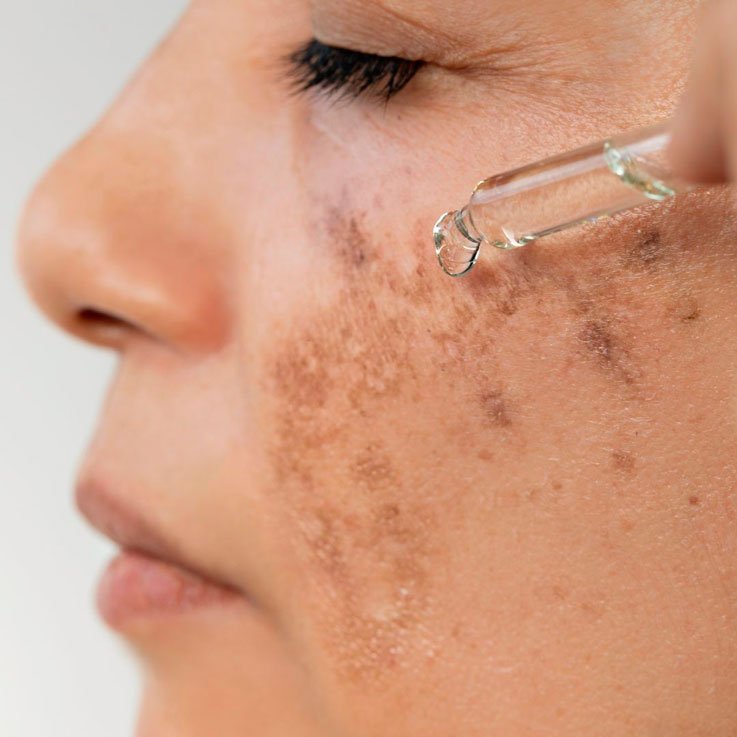 Diferencia entre melasma y cloasma: causas, tratamientos y cómo eliminarlos