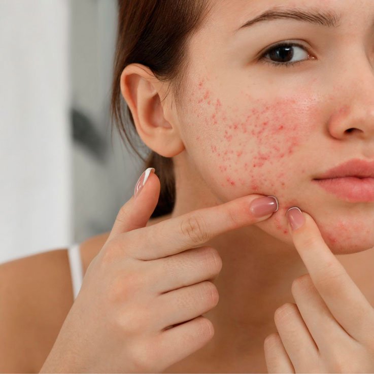 Acné Hormonal: causas, síntomas y los mejores tratamientos para eliminarlo