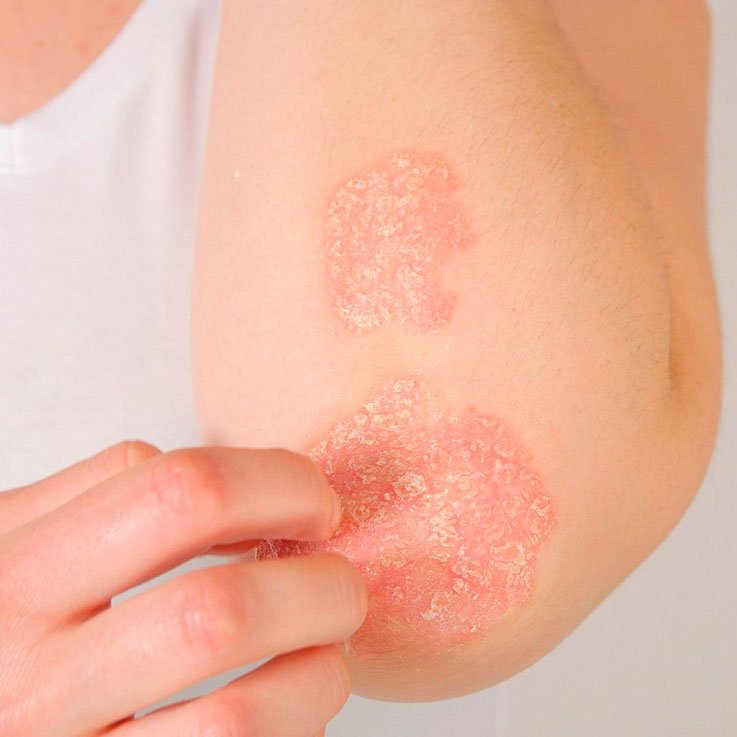 Mejores remedios y cremas naturales para aliviar la psoriasis