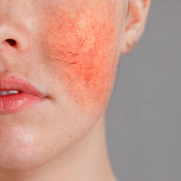 Tratamiento Natural para la Rosácea: 8 Consejos Prácticos con las Mejores Cremas de Såper