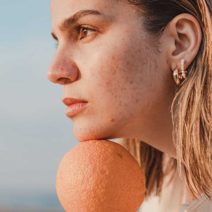 ¿Cómo deshacerse de los granos en la cara? Consejos y tratamiento