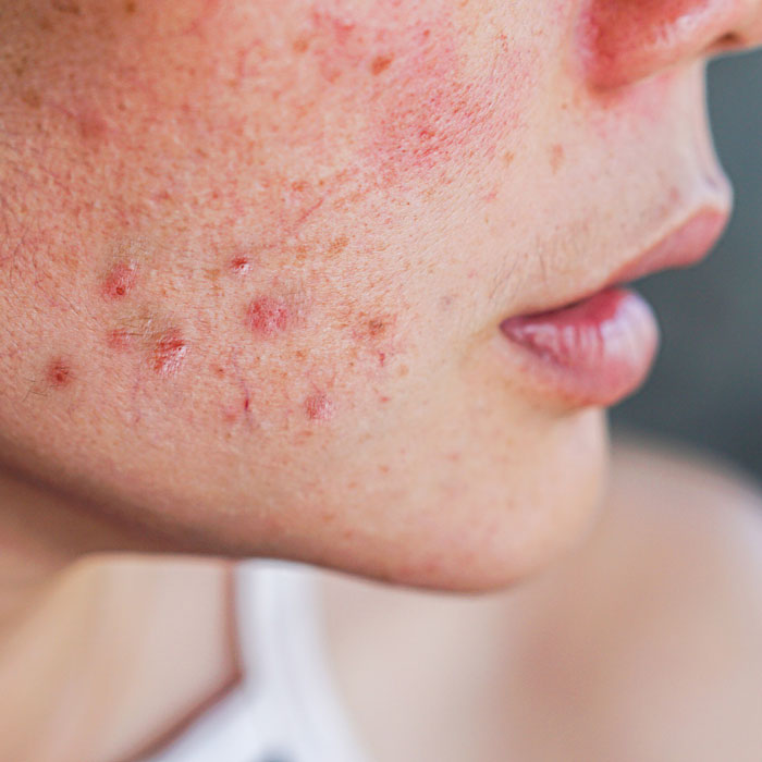 ¿Cómo quitar las marcas de Acné?